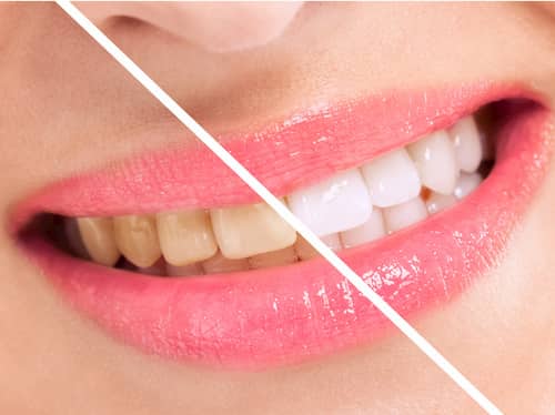 Weiße Zähne: Vergleichsbild von weißen und verfärbten Zähnen